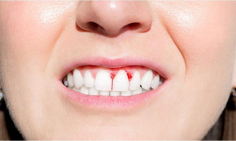 What causes bleeding gums | infooralhealth.com |