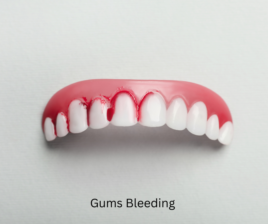 bleeding gums 