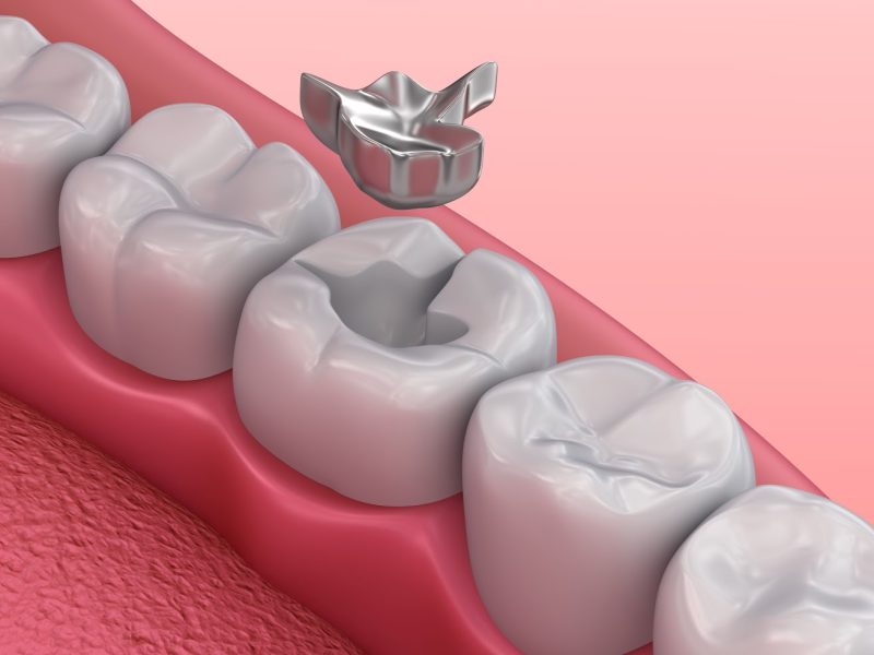 types of dental fillings | infooralhealth.com