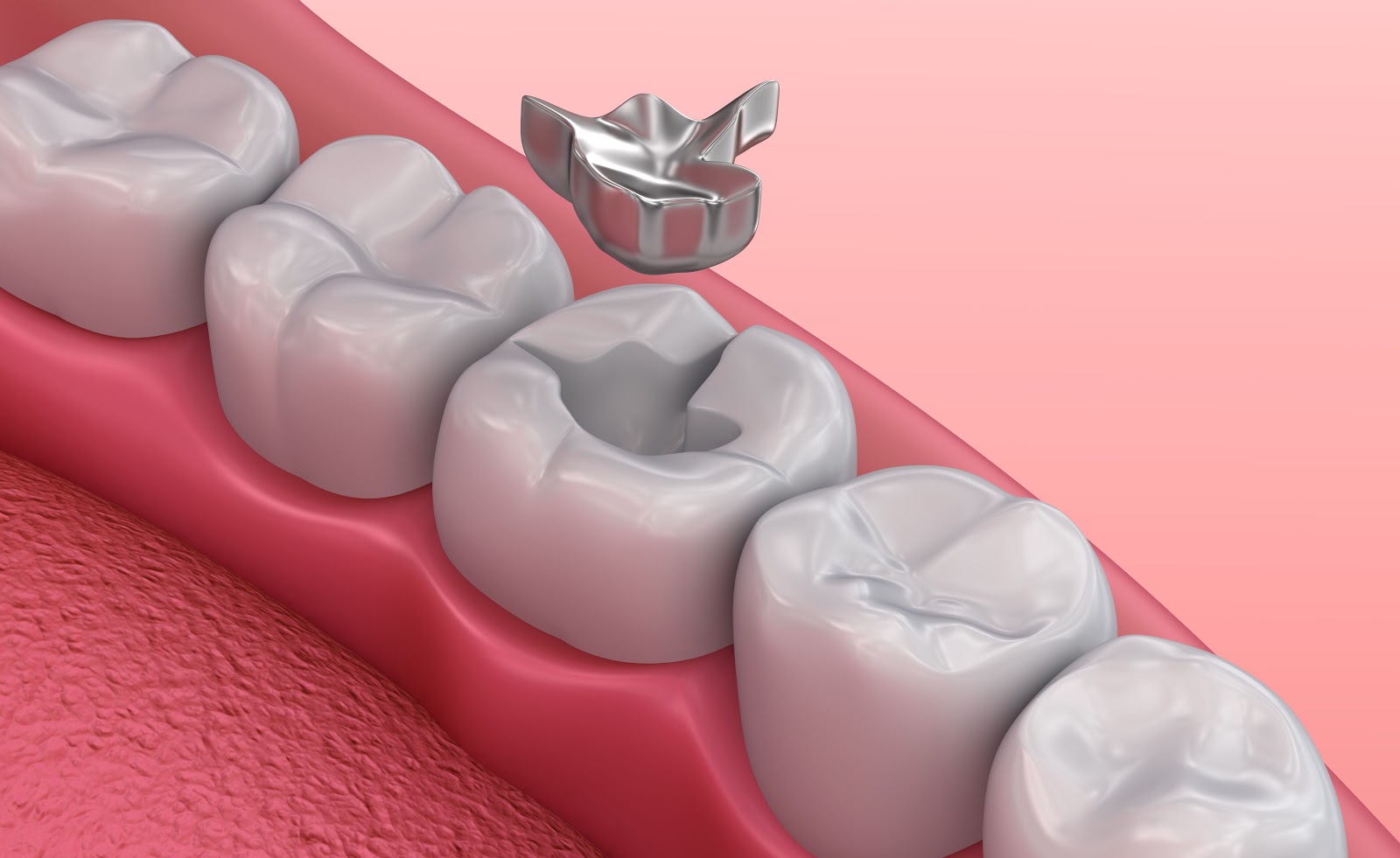 types of dental fillings | infooralhealth.com